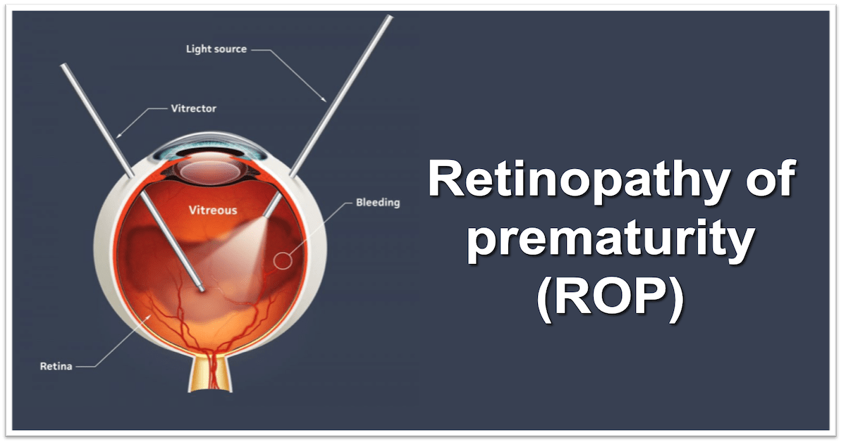 Retinopathy of prematurity (ROP) । প্রিম্যাচিওর শিশুদের অন্ধত্ব এর জন্য দায়ী ঘাতক ব্যাধি
